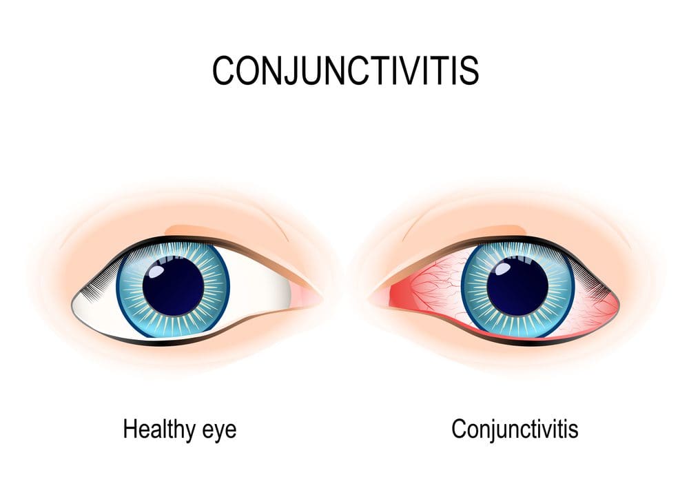 healthy vs conjunctivitis
