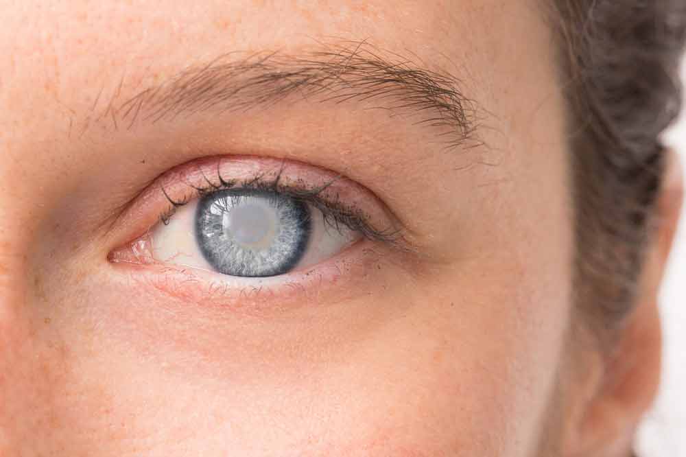 Types Of Cataracts Nuclear Cortical Others NVISION Eye Centers