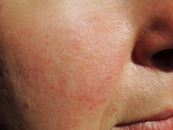 woman with rosacea