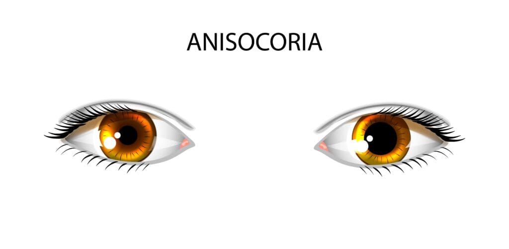 one pupil bigger than the other anxiety