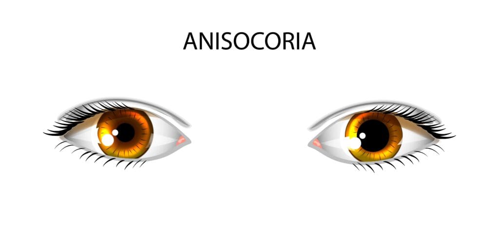 unequal pupil size but constrict equally