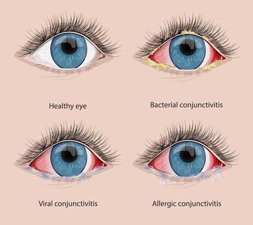 Conjunctivitis Pink Eye Causes And Real Treatments