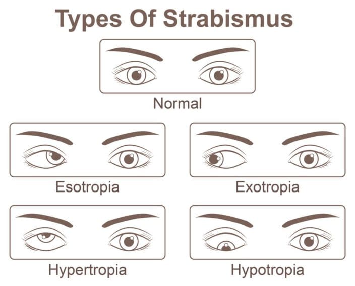 Strabismus (Crossed Eyes) - All About Vision