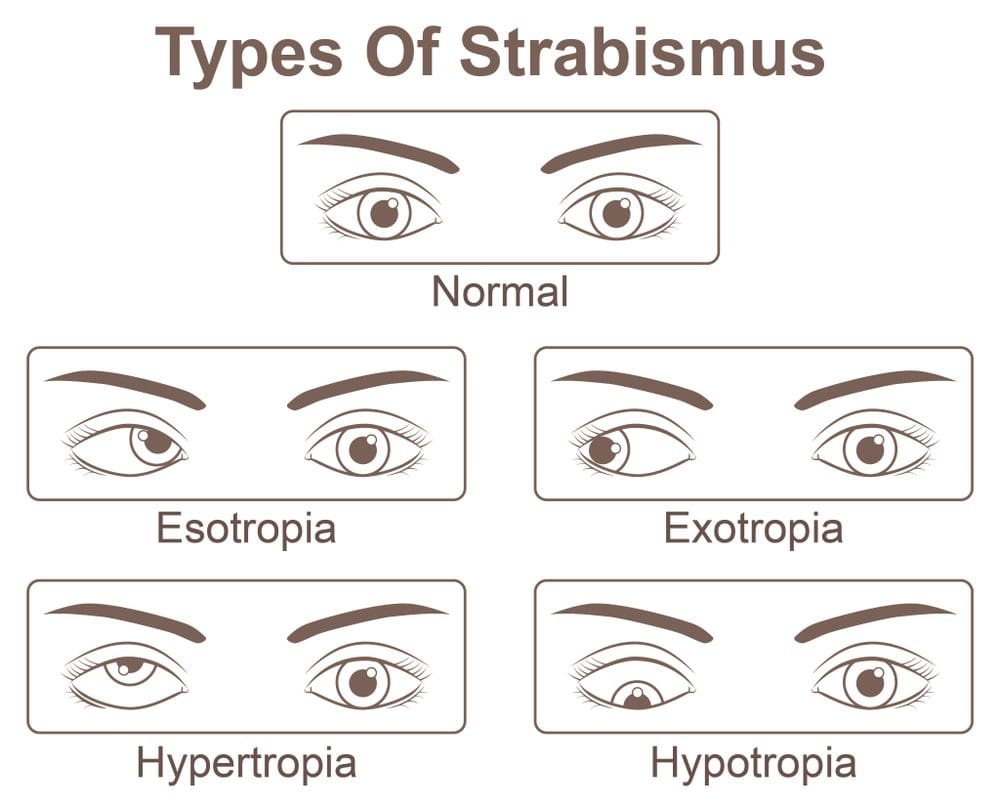 Strabismus is when a...