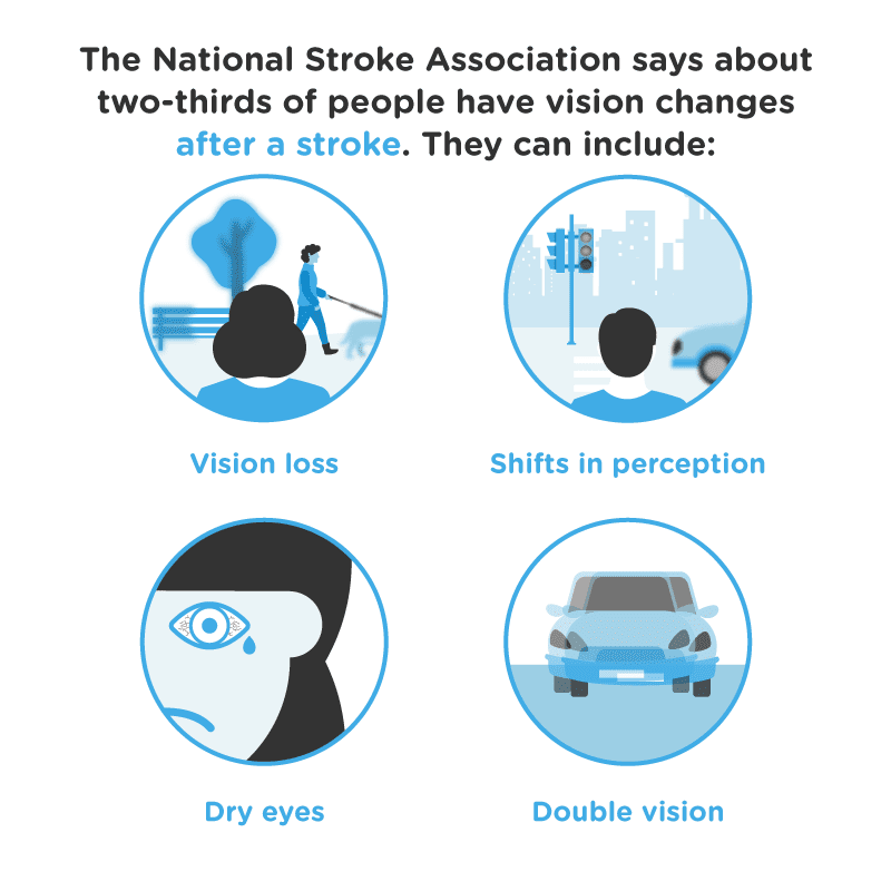 stroke asset