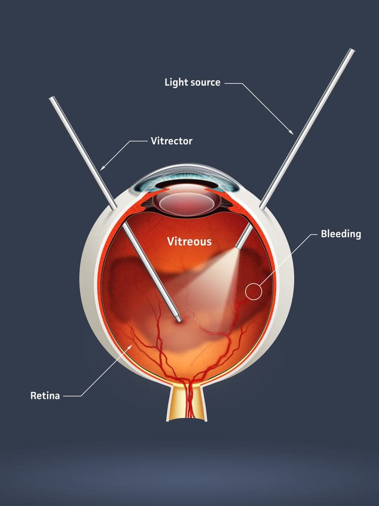 A vitrectomy is a ty...
