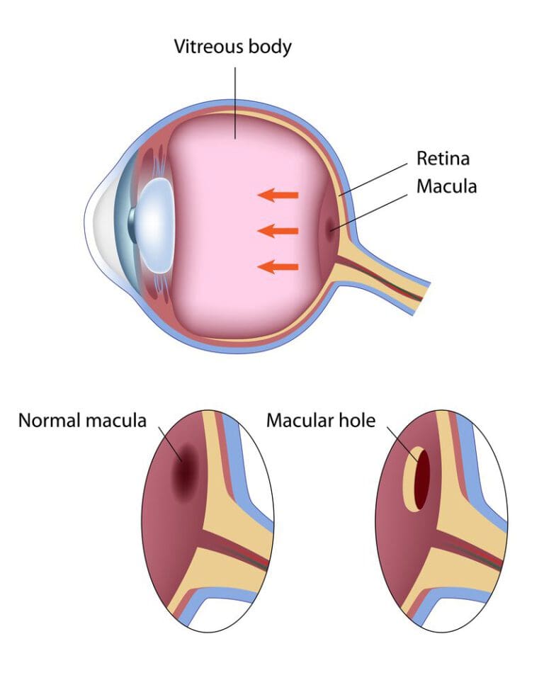 Pros & Cons of Using Avastin to Treat Macular Degeneration NVISION